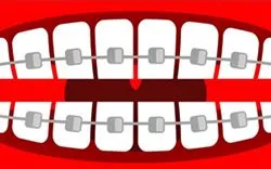 Cómo buscar una clínica dentista para poner brackets