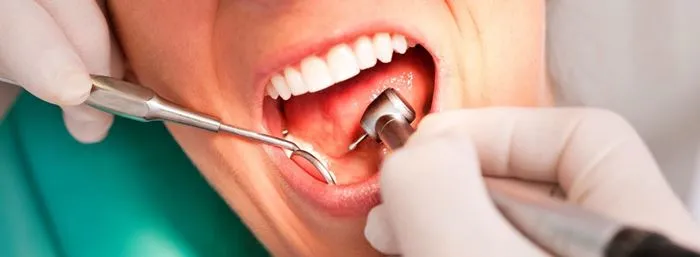 Dentista para limpieza de boca